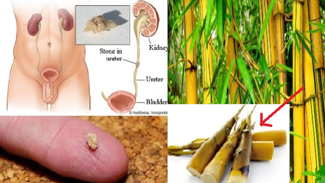 Dokterpun Terkejut Melihat Keajaiban Ini " Dalam Waktu 5 Menit,,Batu Ginjal ((Kencing Batu)) 100% Hancur Seketika Dengan Rebung Bambu Kuning
