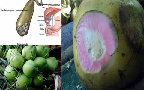 Sampaikan Pada Orang Tua Anda Tak Perlu Operasi Lagi Air Buah Ini Terbukti Ampuh Hancurkan Batu Empedu Begini Langkah Mengolahnya.... 